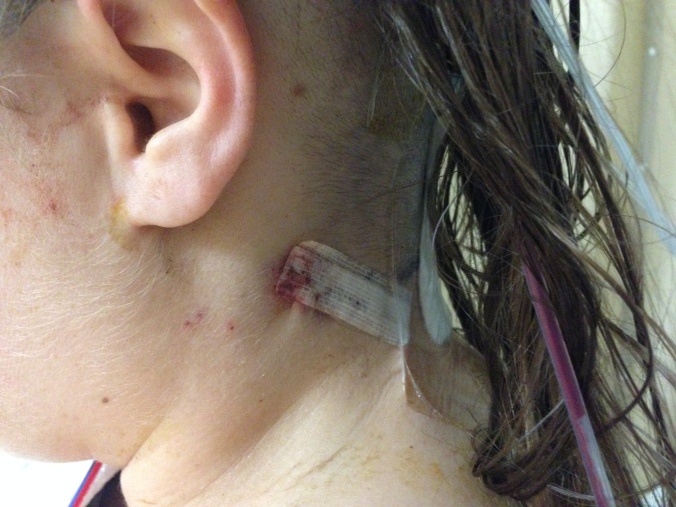 Back-side of the left side of my head, post surgery. 